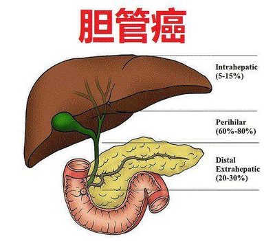 胆管癌：沉默的“胆道杀手”，早识别早干预是关键