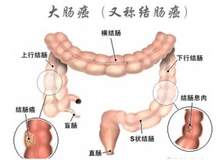 大肠癌：最“笨”的癌症