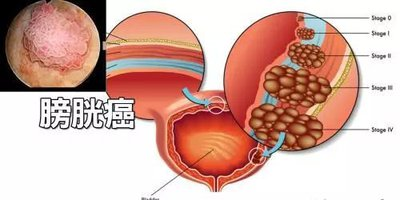 膀胱癌：血尿的“红色警报”，早发现早治疗是关键