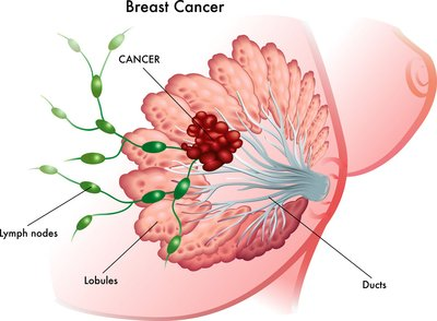 乳腺癌：女性“头号杀手”，可防可治不可怕