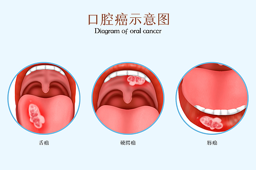 溃烂不愈的“小口疮”要当心——认识口腔癌