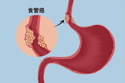 “烫”出来的危险？——关于食道癌，你了解多少？
